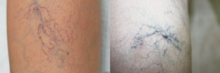 Symptômes de varices