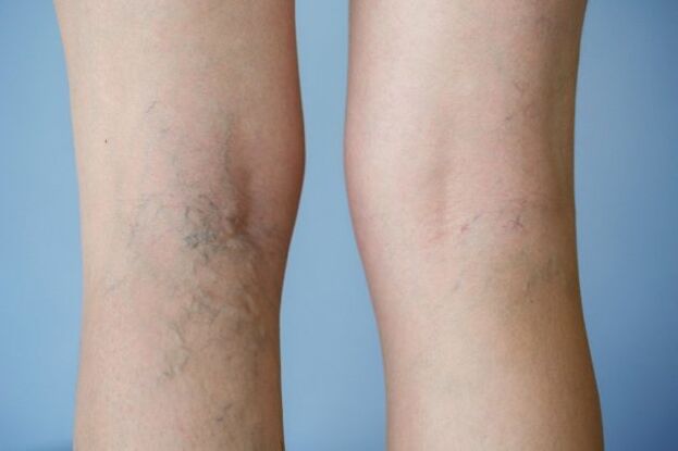 varices