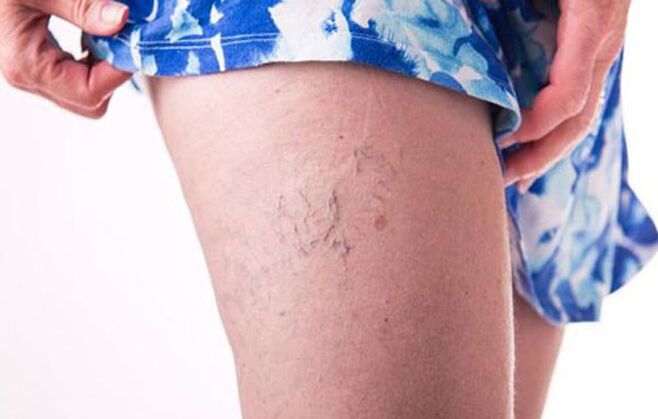 Varices dans la jambe