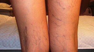 Comment traiter l'expansion du varicon chez les femmes chez les femmes