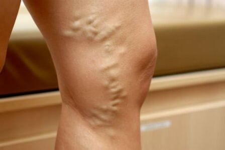 médicaments contre les varices
