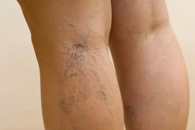 Pathologie veineuse des jambes.