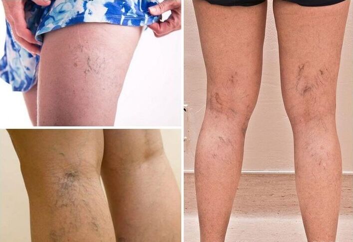 varices sur les jambes