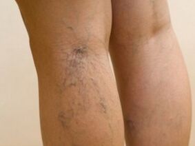 Les veines saillantes sous la peau sont un symptôme de varices dans les jambes. 